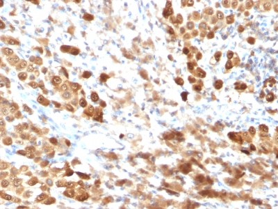 Formalin-fixed, paraffin-embedded human Melanoma stained with S1B Mouse Monoclonal Antibody (SPM354).