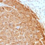 Formalin-fixed, paraffin-embedded human Melanoma stained with S1B Mouse Monoclonal Antibody (SH-B1).