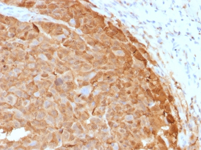 Formalin-fixed, paraffin-embedded human Melanoma stained with S1B Mouse Monoclonal Antibody (SH-B1).