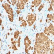 Formalin-fixed, paraffin-embedded human Melanoma  stained with S1B Rabbit Monoclonal Antibody (S1B/176R).