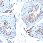 Formalin-fixed, paraffin-embedded human Testicular Carcinoma stained with SHBG Monoclonal Antibody (SHBG/245)