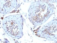 Formalin-fixed, paraffin-embedded human Testicular Carcinoma stained with SHBG Monoclonal Antibody (SHBG/245)