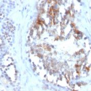 Formalin-fixed, paraffin-embedded human Testicular Carcinoma stained with SHBG Monoclonal Antibody (SPM65)