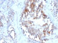 Formalin-fixed, paraffin-embedded human Testicular Carcinoma stained with SHBG Monoclonal Antibody (SPM65)