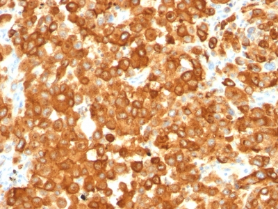 Formalin-fixed, paraffin-embedded human Testis stained with gp1 / Melanosome Monoclonal Antibody (HMB45).