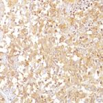 Formalin-fixed, paraffin-embedded human Melanoma stained with gp1 / Melanosome Monoclonal Antibody (SPM142).