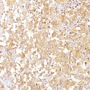 Formalin-fixed, paraffin-embedded human Melanoma stained with gp1 / Melanosome Monoclonal Antibody (SPM142).