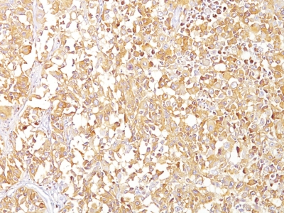 Formalin-fixed, paraffin-embedded human Melanoma stained with gp1 / Melanosome Monoclonal Antibody (SPM142).