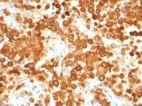 Formalin-fixed, paraffin-embedded human Testis stained with gp1 / Melanosome Monoclonal Antibody (HMB45 + PMEL/783).