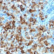 Formalin-fixed, paraffin-embedded human Melanoma stained with gp1 Recombinant Rabbit Monoclonal Antibody (PMEL/1825R).
