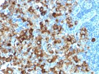 Formalin-fixed, paraffin-embedded human Melanoma stained with gp1 Recombinant Rabbit Monoclonal Antibody (PMEL/1825R).