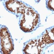 Formalin-fixed, paraffin-embedded human Testicular Carcinoma stained with SUMO-2 Monoclonal Antibody (SPM572)
