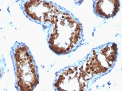 Formalin-fixed, paraffin-embedded human Testicular Carcinoma stained with SUMO-2 Monoclonal Antibody (SPM572)