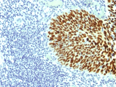 Formalin-fixed, paraffin-embedded Human Cervical Carcinoma stained with SOX2 Monoclonal Antibody (SOX2/1791).