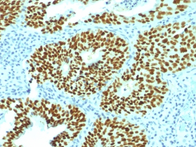 Formalin-fixed, paraffin-embedded Human Cervical Carcinoma stained with SOX2 Monoclonal Antibody (SOX2/1792).