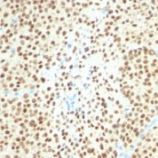 Formalin-fixed, paraffin-embedded human Melanoma stained with SOX1 Monoclonal Antibody (SPM67).