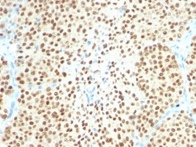 Formalin-fixed, paraffin-embedded human Melanoma stained with SOX1 Monoclonal Antibody (SPM67).