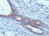 Formalin-fixed, paraffin-embedded human Breast Carcinoma stained with BRCA1 Monoclonal Antibody (BRCA1/1398).