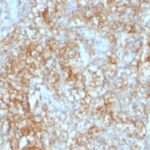 Formalin-fixed, paraffin-embedded human Renal Cell Carcinoma stained with CD147 Monoclonal Antibody (8D6).