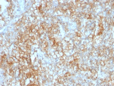 Formalin-fixed, paraffin-embedded human Renal Cell Carcinoma stained with CD147 Monoclonal Antibody (8D6).