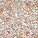 Formalin-fixed, paraffin-embedded human Colon Carcinoma stained with CD147 Monoclonal Antibody (BSG/963).