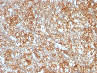 Formalin-fixed, paraffin-embedded human Colon Carcinoma stained with CD147 Monoclonal Antibody (BSG/963).