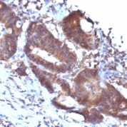 Formalin-fixed, paraffin-embedded human Colon Carcinoma stained with Transgelin Monoclonal Antibody (TAGLN/247)