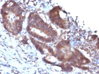 Formalin-fixed, paraffin-embedded human Colon Carcinoma stained with Transgelin Monoclonal Antibody (TAGLN/247)