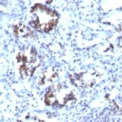 Formalin-fixed, paraffin-embedded human Colon Carcinoma stained with Transgelin Monoclonal Antibody (SPM66)