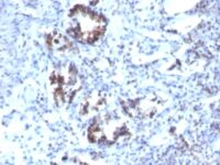 Formalin-fixed, paraffin-embedded human Colon Carcinoma stained with Transgelin Monoclonal Antibody (SPM66)