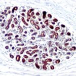 Formalin-fixed, paraffin-embedded human Ovarian Carcinoma stained with pS2 Monoclonal Antibody (GE2).