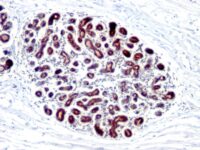 Formalin-fixed, paraffin-embedded human Ovarian Carcinoma stained with pS2 Monoclonal Antibody (GE2).