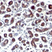 Formalin-fixed, paraffin-embedded human Breast Carcinoma stained with pS2 Monoclonal Antibody (SPM573).