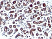 Formalin-fixed, paraffin-embedded human Breast Carcinoma stained with pS2 Monoclonal Antibody (SPM573).