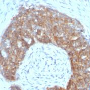 Formalin-fixed, paraffin-embedded human Ovarian Carcinoma stained with pS2 Monoclonal Antibody (SPM313).
