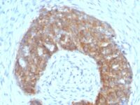 Formalin-fixed, paraffin-embedded human Ovarian Carcinoma stained with pS2 Monoclonal Antibody (SPM313).