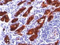 Formalin-fixed, paraffin-embedded human Thyroid stained with Thyroglobulin Monoclonal Antibody (2H11).