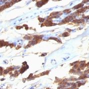 Formalin-fixed, paraffin-embedded human Thyroid Carcinoma stained with Thyroglobulin Monoclonal Antibody (SPM221).