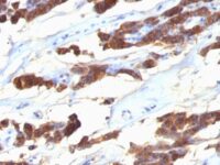 Formalin-fixed, paraffin-embedded human Thyroid Carcinoma stained with Thyroglobulin Monoclonal Antibody (SPM221).