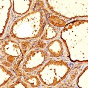 Formalin-fixed, paraffin-embedded human Thyroid stained with Thyroglobulin Monoclonal Antibody (6E1).
