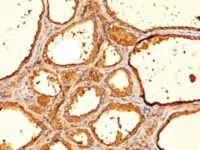 Formalin-fixed, paraffin-embedded human Thyroid stained with Thyroglobulin Monoclonal Antibody (6E1).