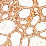 Formalin-fixed, paraffin-embedded human Thyroid Carcinoma stained with Thyroglobulin Monoclonal Antibody (SPM517).