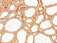 Formalin-fixed, paraffin-embedded human Thyroid Carcinoma stained with Thyroglobulin Monoclonal Antibody (SPM517).