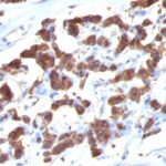 Formalin-fixed, paraffin-embedded human Thyroid stained with Thyroglobulin Ab (2H11 + 6E1).