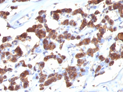 Formalin-fixed, paraffin-embedded human Thyroid stained with Thyroglobulin Ab (2H11 + 6E1).