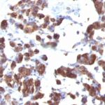 Formalin-fixed, paraffin-embedded human Thyroid stained with Thyroglobulin Monoclonal Antibody (TGB4 + TGB5).