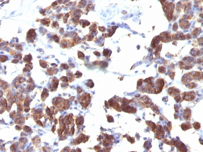 Formalin-fixed, paraffin-embedded human Thyroid stained with Thyroglobulin Monoclonal Antibody (TGB4 + TGB5).