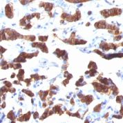 Formalin-fixed, paraffin-embedded human Thyroid Carcinoma stained with Thyroglobulin Monoclonal Antibody (TGB24).