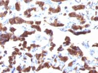 Formalin-fixed, paraffin-embedded human Thyroid Carcinoma stained with Thyroglobulin Monoclonal Antibody (TGB24).