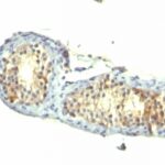 Formalin-fixed, paraffin-embedded human Testicular Carcinoma stained with TGF alpha Monoclonal Antibody (1E8-G6)